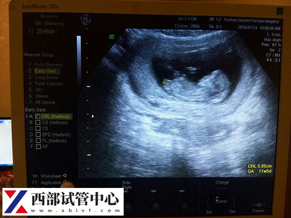 试管一超二超三超检查时间