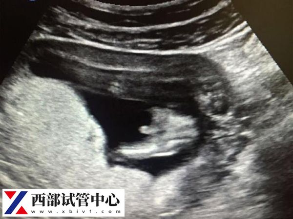 试管一超二超三超检查时间(图3) 二次B超是移植后的6-7周实施