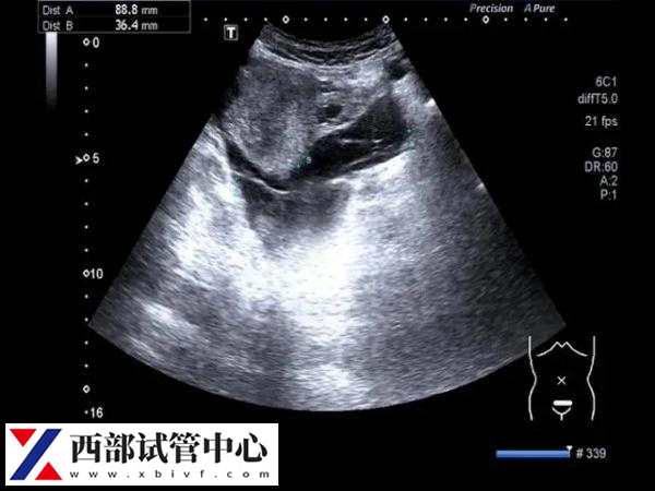 卵黄囊通常在怀孕的第5到第10周之间可见