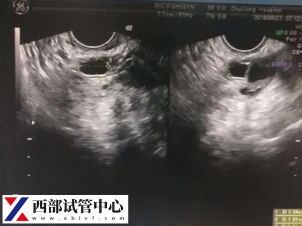 监测排卵可以找到排卵期