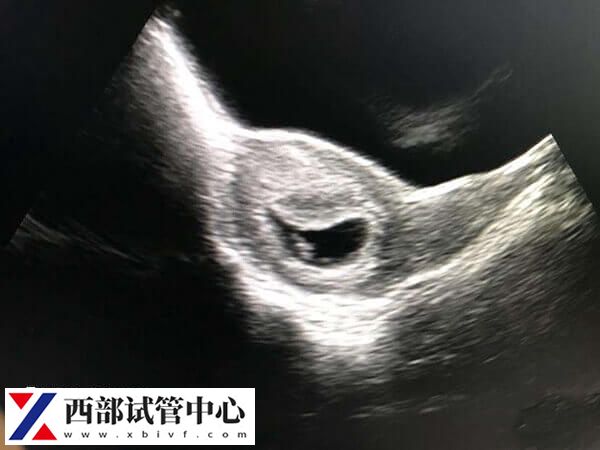 刮宫后多久可以移植胚胎